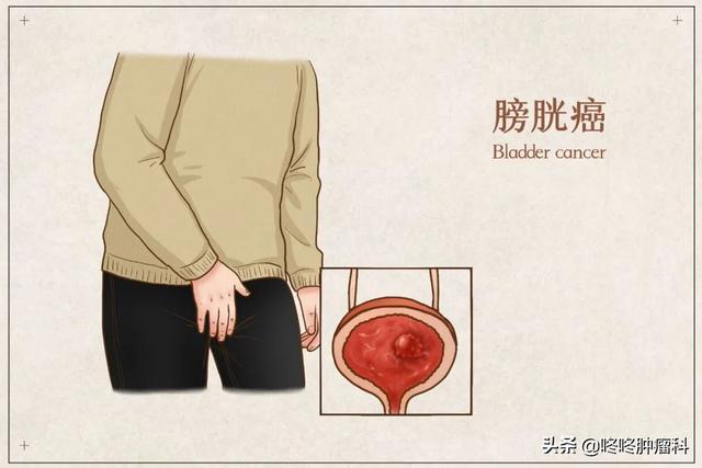 腰椎間盤突出、肩周炎:這些常見的不適癥狀,很有可能是癌癥的征兆