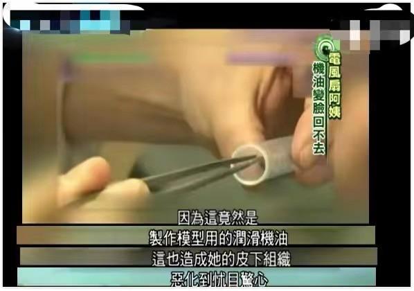 韩慧景：把自己整成“电风扇”，注射食用油代价惨痛，我悔不当初