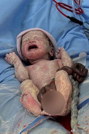 英国宝宝出生时肠子长在体外 已手术成功出院 父母取名“勇士”