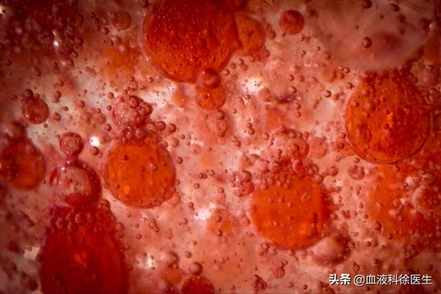 45岁大叔，每天吃洋葱降血脂，一个月后他的血脂有啥变化？