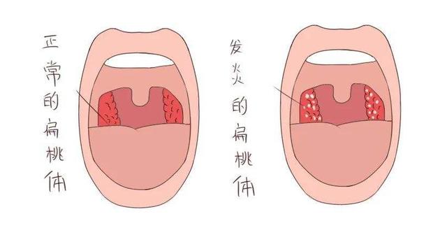 如果患者是因為患有急性化膿性扁桃體炎,從而導致不良症狀的產生,這種