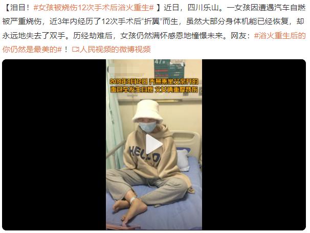 乔燕：因汽车自燃被烧伤，全脸毁容双手截肢，928天后涅槃重生