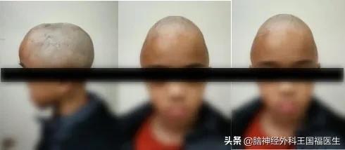 孩子忽然呆住持续1分钟，上课突然起身，是癫痫？!还有隐藏病因..