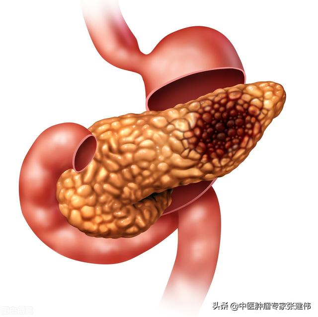 “胃病”患者出現這6個表現，當心是胰腺癌“信號”，千萬別忽視