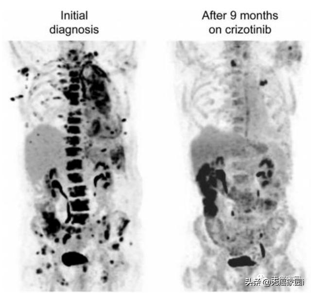 多处脑转移2个月后完全缓解，MET抑制剂卡马替尼逆转肺癌复发转移