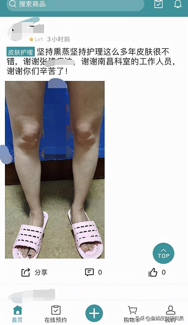 鱼鳞皮肤病奇痒怎么办