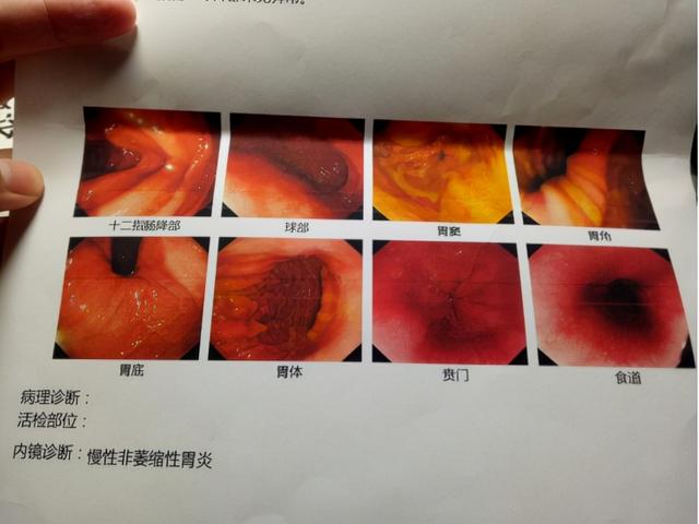 总感觉喉咙有异物，但吃饭喝水没问题？中医1个经典方，帮你搞定