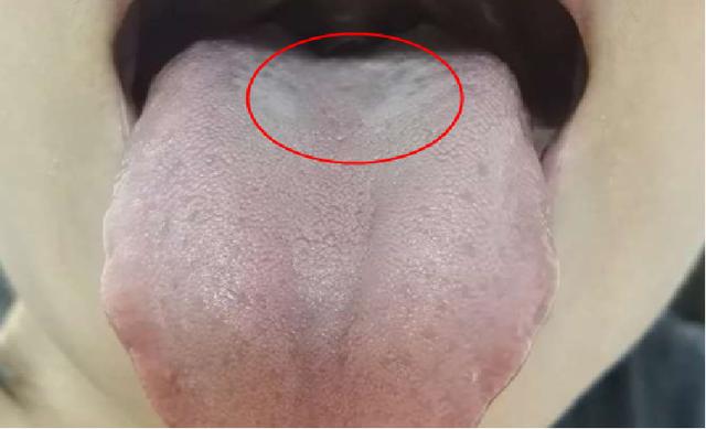 气虚怎么补？通过舌象告诉你如何精准参考中成药，学会不走弯路