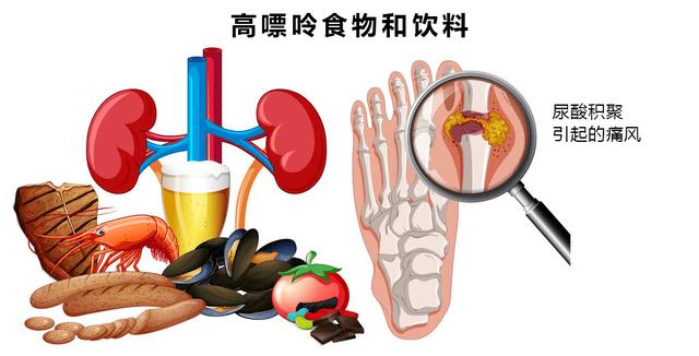 肾结石和痛风如果都急性发作，你猜疼痛感觉能一样吗？