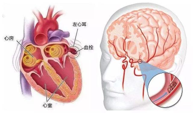 脑梗和脑血栓，有什么不一样？医生：一个是果，一个是因