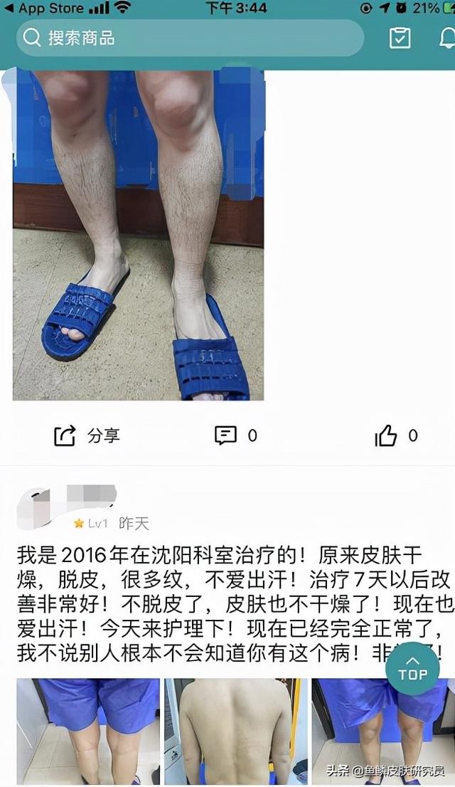 鱼鳞皮肤病奇痒怎么办