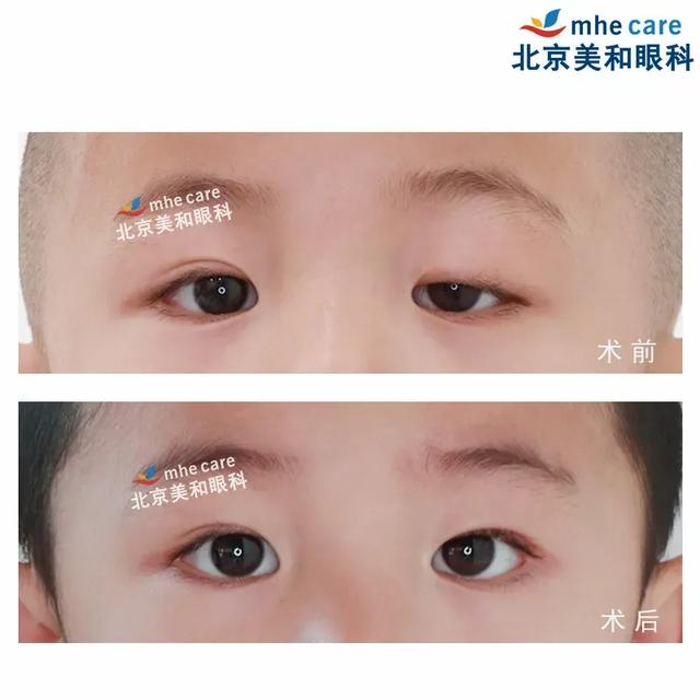 五年八部曲，上睑下垂分阶段治疗的故事