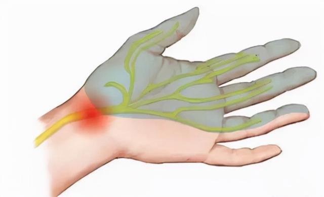 如何正确辨别早晨起来手麻的真正原因