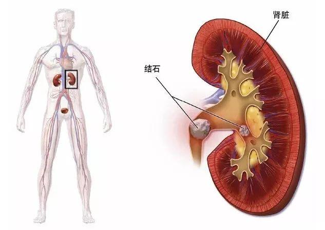 肾结石和痛风如果都急性发作，你猜疼痛感觉能一样吗？
