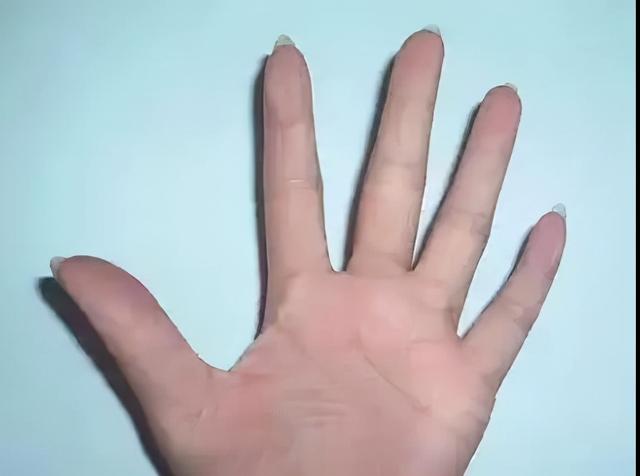 鱼鳞病手脚角化