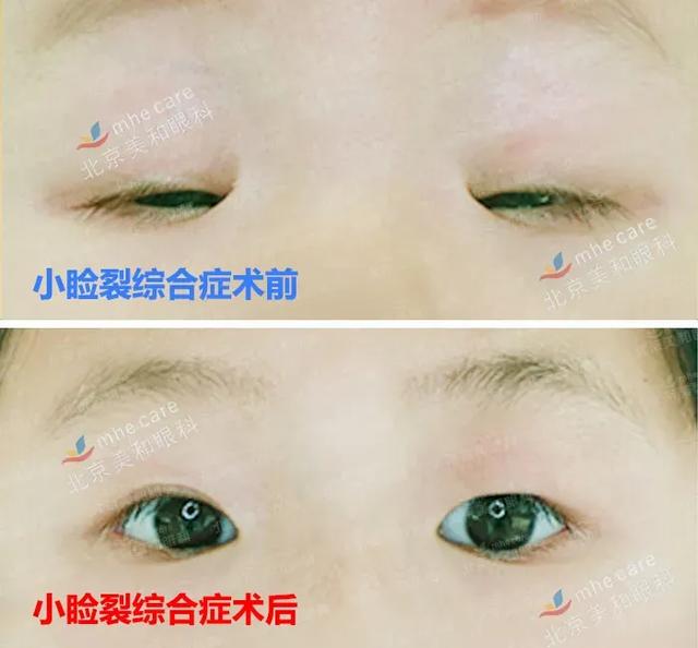 五年八部曲，上睑下垂分阶段治疗的故事