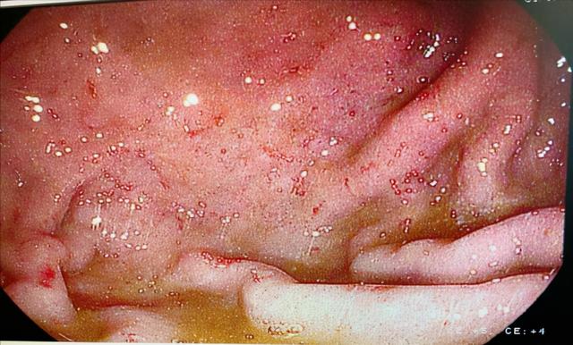 胃在什么位置图片胃在什么位置图片示意图