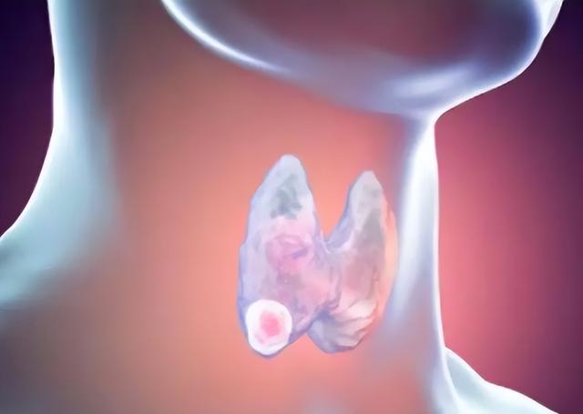 羊肉是甲状腺疾病的“发物”？提醒：除了羊肉，2种肉或要少碰