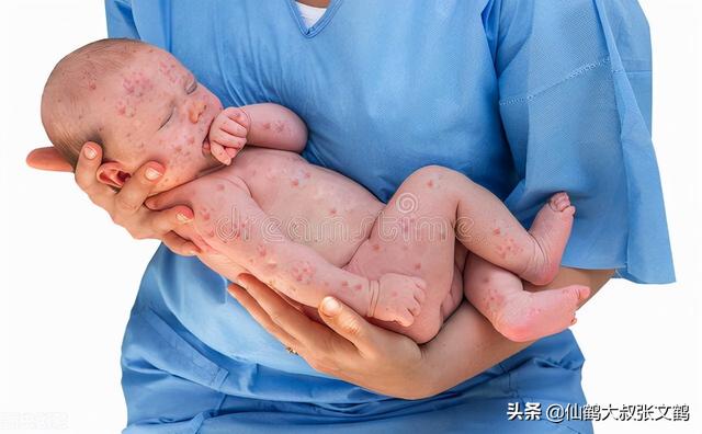 孩子冬季起红疹子的四个阶段