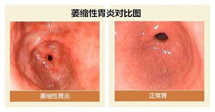 萎缩性胃炎饮食注意事项，能吃什么？不能吃什么食物？2022收藏版
