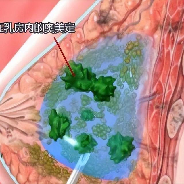 “胸”跑到了背上，只因注射了奧美定