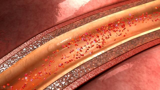 刁永鹏医师：熟悉的血管堵塞和这3个方面有关系，你可能还不知道
