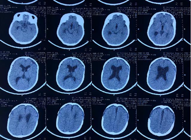 为一个罕见病患儿做手术