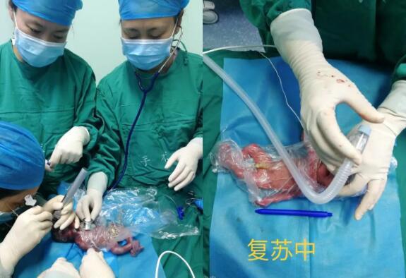 巴掌大超早产宝宝，152天“生命闯关”