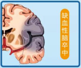 世界卒中日 | 天气转凉，快教会爸妈预防卒中“4要点”