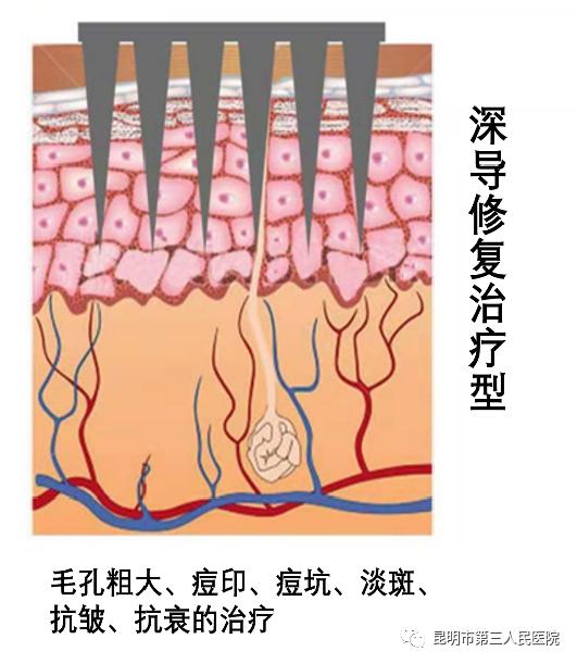 鸡皮肤去除医美