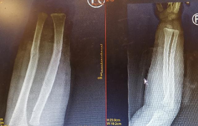 4龄童滑滑梯时意外骨折，纯手法复位20秒快速搞定