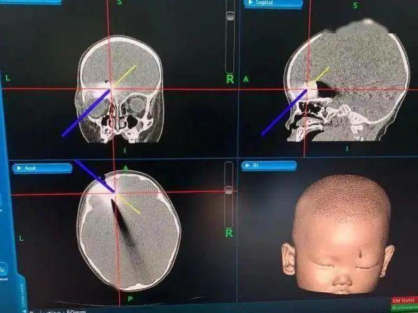 揪心！1岁女婴颅内留下4厘米断刀……
