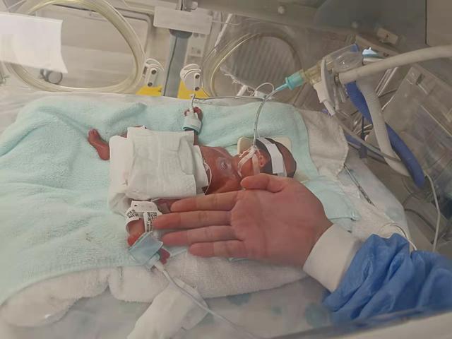 生命奇迹！630克“巴掌宝宝”闯关活下来了