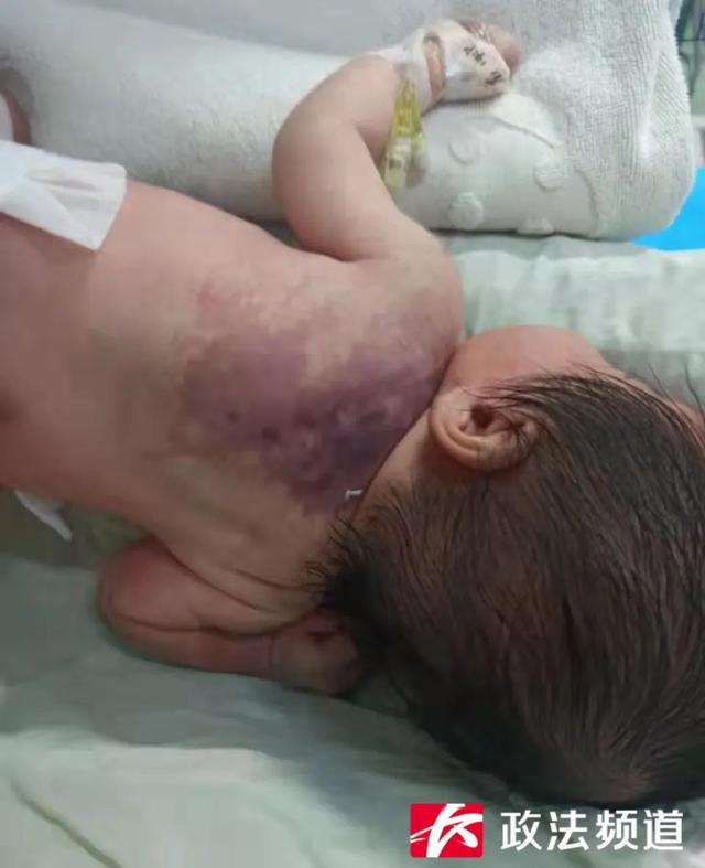 出生28天体重仅3.9公斤，婴儿确诊卡梅综合征！医生：孩子出现这些症状马上就医