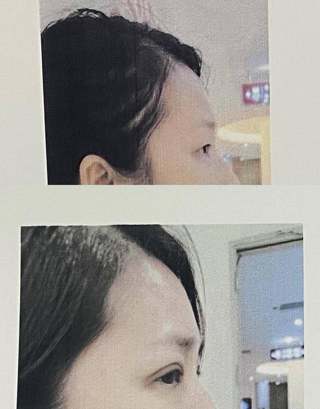 上海女子被封医生隔栅栏双眼皮拆线