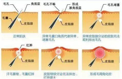 激光去除鸡皮肤有效吗