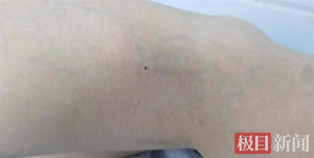 假期露营受追捧，专家：野外郊游警惕蜱虫咬伤