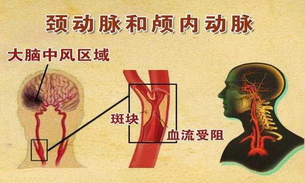 如何有效预防和避免脑卒中？不妨做个颈动脉彩超检查