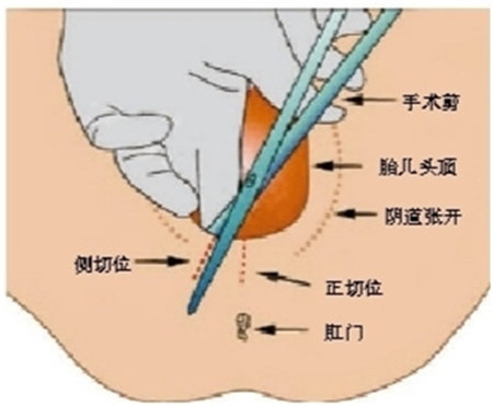 顺产侧切需要拆线吗