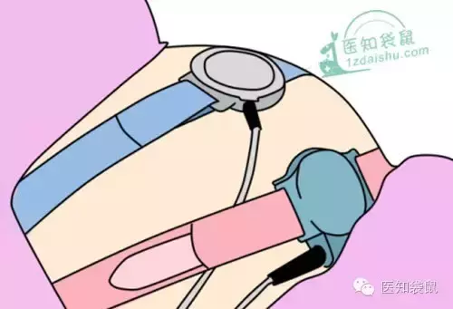 胎心监护可判断胎儿是否缺氧！教你一分钟看懂检查结果