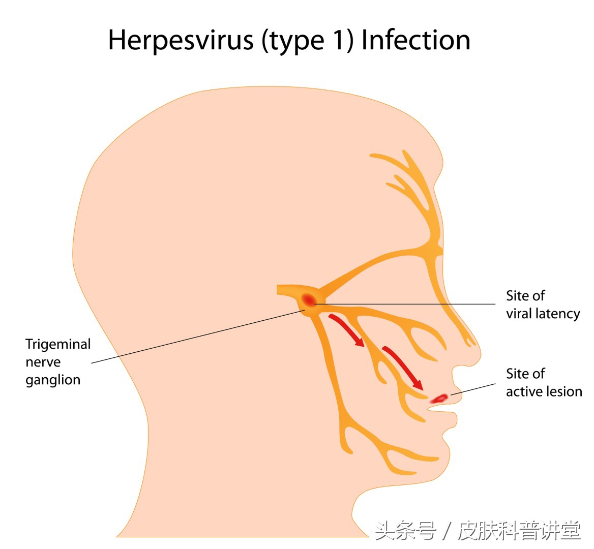 皮肤科门诊之聊一聊皮肤科的“上火”（单纯性疱疹）