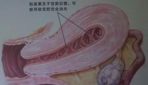 继发性闭经怎么治？扫除年轻女性备孕路上的拦路虎