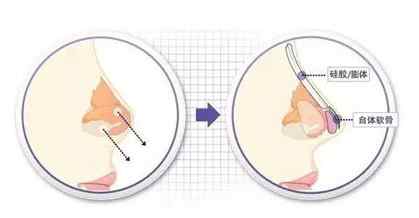 隆鼻一定要用假体？NO~其实自身材料也可以！