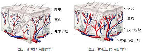 医学探秘：人体皮肤结构与胎记皮肤病理特征