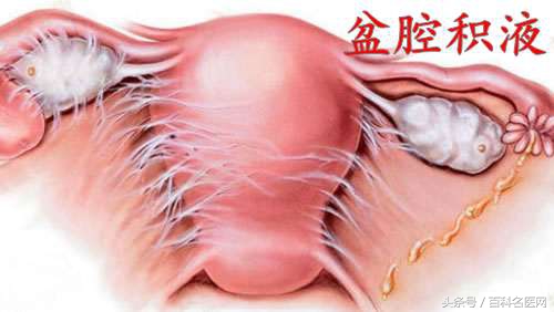 盆腔积液是严重的妇科病?专家说这个"病"不需要治