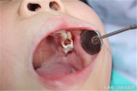 4种原因导致牙髓与根尖疾病，牙痛起来要你命！2种药物即刻止痛