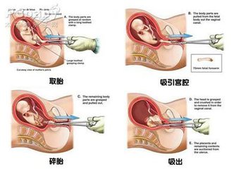 流产后怎么调养身体？