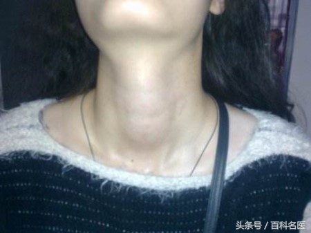甲状腺结节一定要做手术吗？甲状腺囊肿癌变前有哪些征兆？