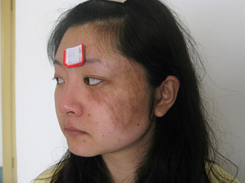 近年来,随着医疗技术的不断提高,以咖啡斑(咖啡牛奶斑),太田痣,鲜红