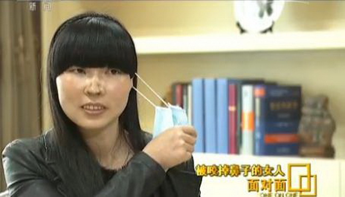 家暴11年（女子被前夫咬掉鼻子被家暴改变人生）